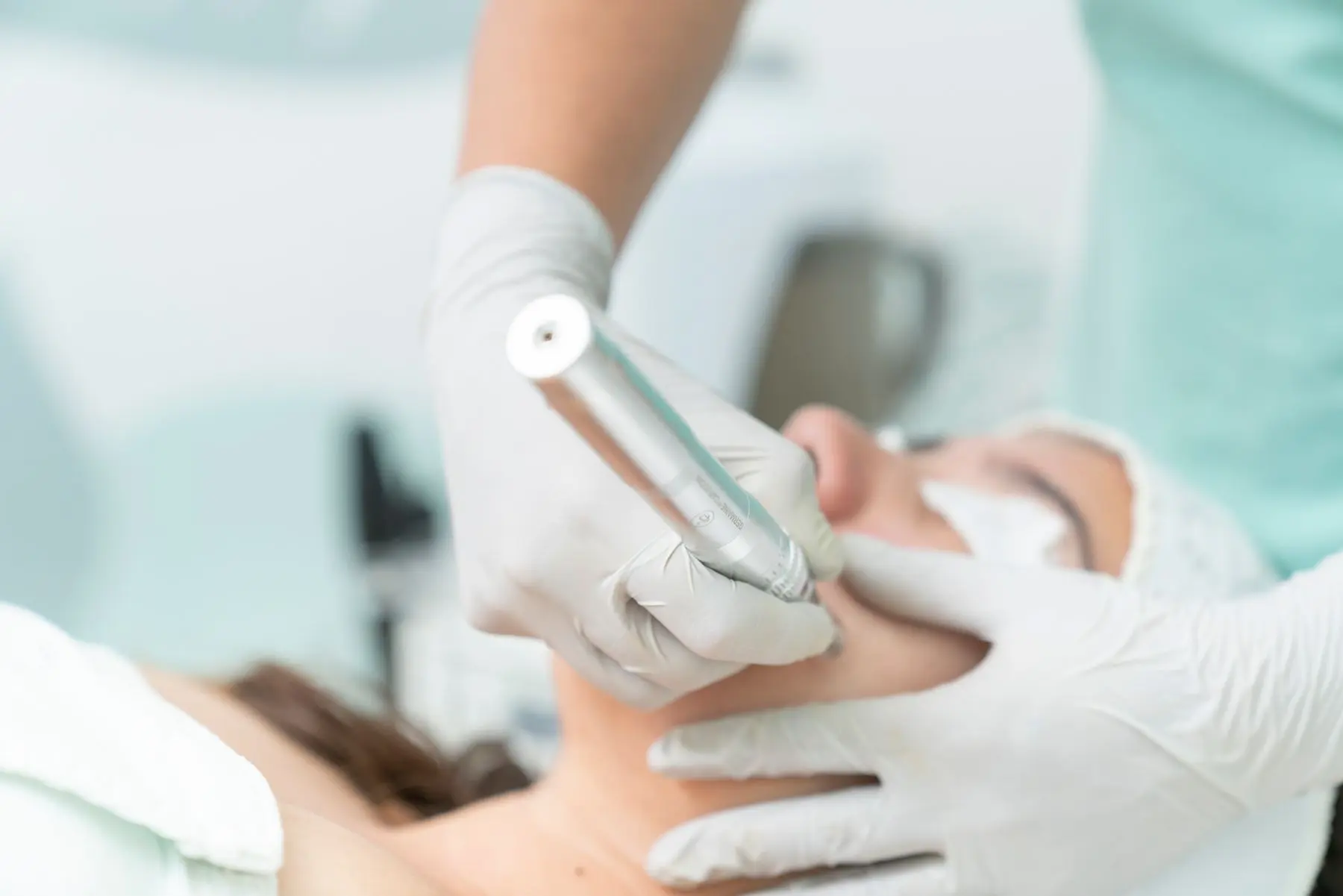 A gloved hand holds a fine treatment pen over a patient's cheek.